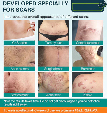 LOVILDS™ Advanced Scar Spray For All Types of Scars - For example Acne Scars, Surgical Scars and Stretch Marks ⚡️⚡️⚡️